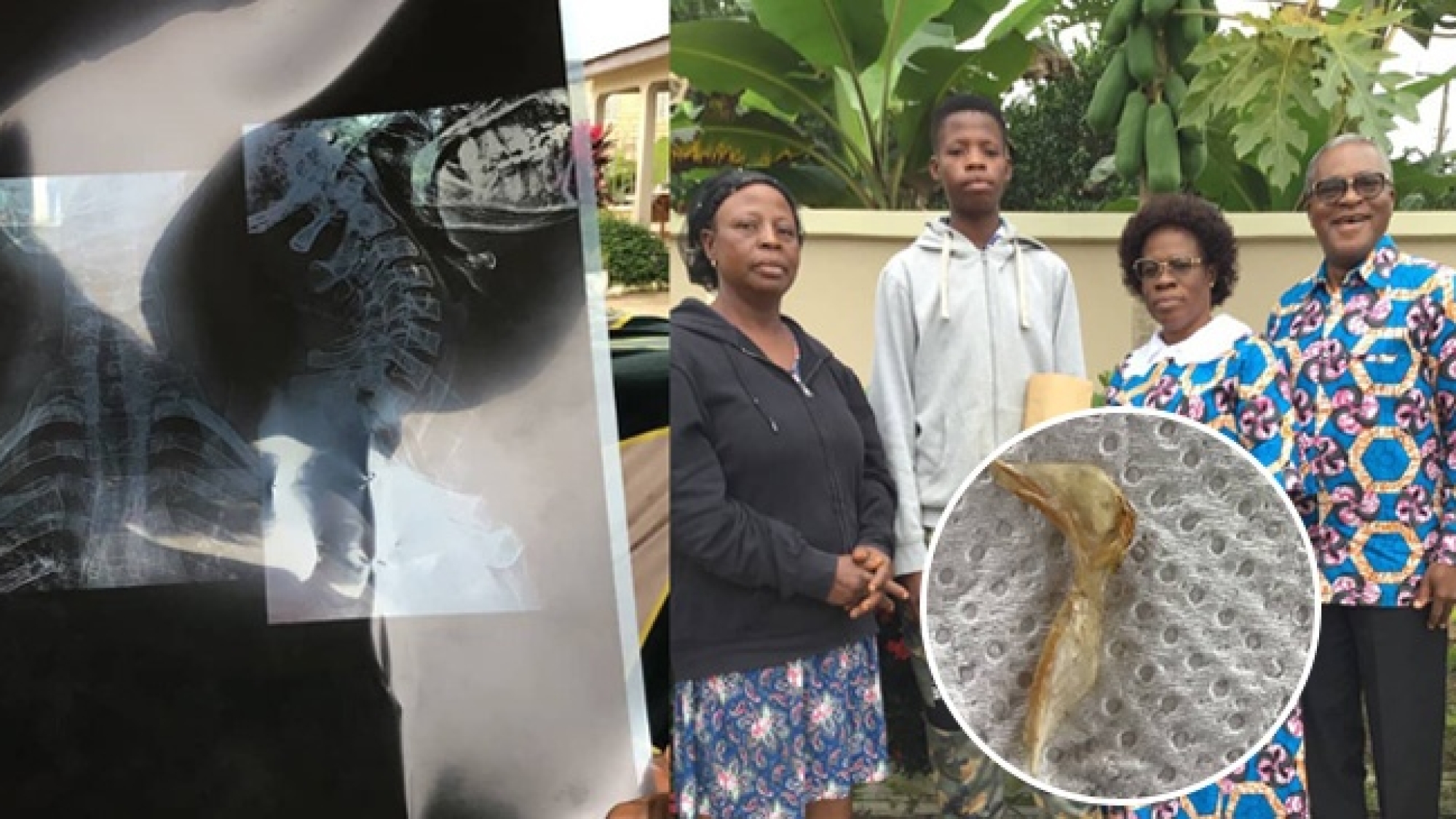 Miraculous Intervention In Boadua Man Vomits Huge Bone web