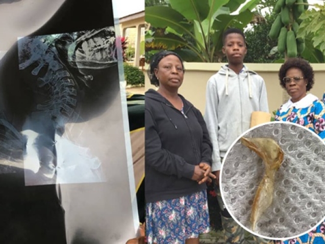Miraculous Intervention In Boadua Man Vomits Huge Bone web