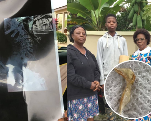 Miraculous Intervention In Boadua Man Vomits Huge Bone web