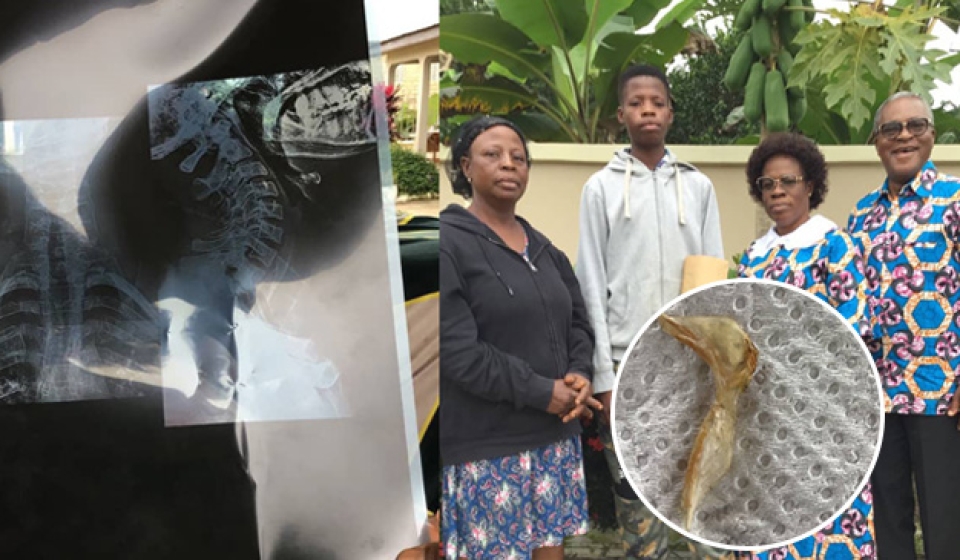 Miraculous Intervention In Boadua Man Vomits Huge Bone web