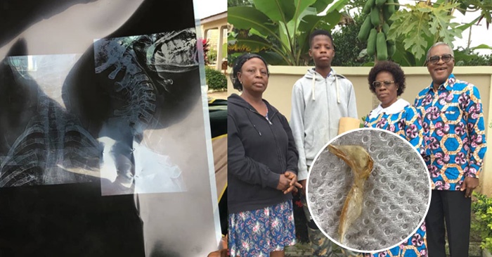 Miraculous Intervention In Boadua: Man Vomits Huge Bone